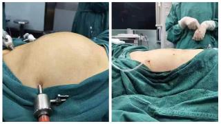 切口仅2cm 重庆大学附属江津医院成功完成一例腹腔镜下巨大子宫切除术