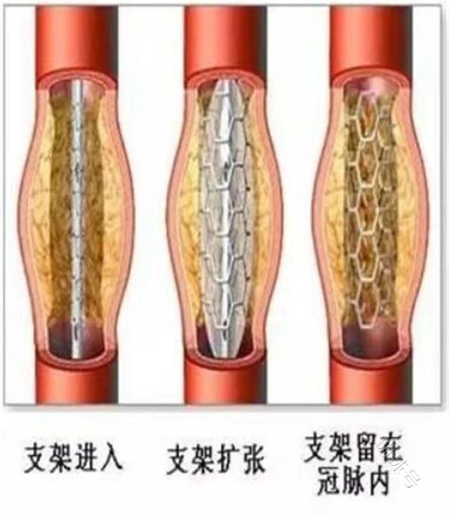 溶栓治疗和支架治疗有什么区别？一文科普下