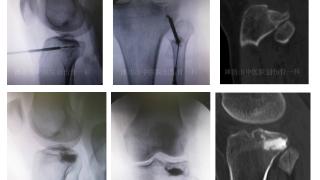 潍坊市中医院巧用椎体成型器械微创治疗胫骨平台骨折