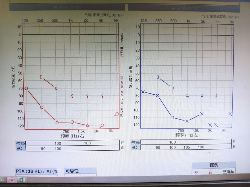 重庆仁品耳鼻喉医院开展首例成人双侧人工耳蜗植入手术