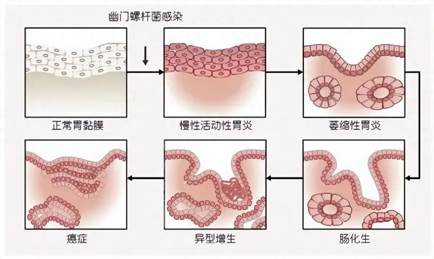 杭州一家5口全中招，1人​癌症！专家​强调：这件事务必注意