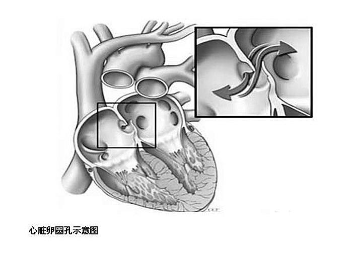 小“心眼”导致大“中风”