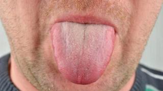 舌中出现裂纹，警惕是脾胃有病，4种常见的裂纹舌，先分清再调理