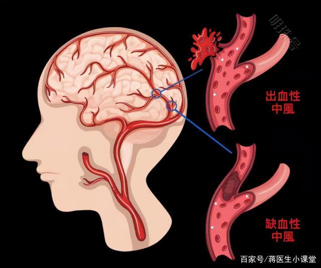 长期服用阿司匹林和他汀，是在治疗脑梗死吗？一文揭晓答案