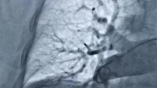 无棣县人民医院心内一科成功开展经皮选择性肺动脉造影术