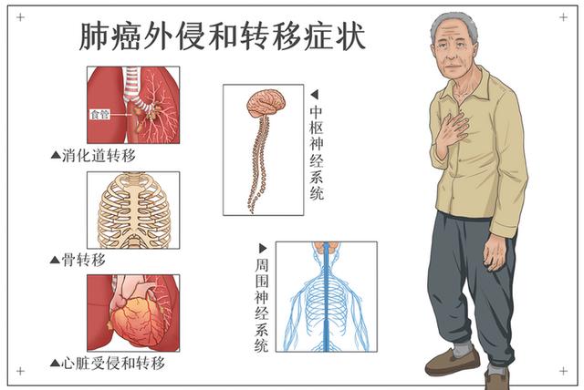 “腰背痛”不缓解，一查竟是癌症！这些疼痛可能是肿瘤的信号