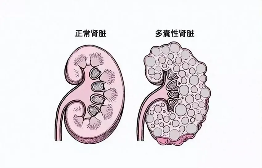 得了多囊肾怎么办？如何治疗多囊肾病？日常做好7个管理