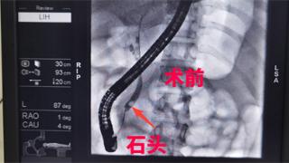 上栗县人民医院开展首例ERCP下胆总管结石取出术