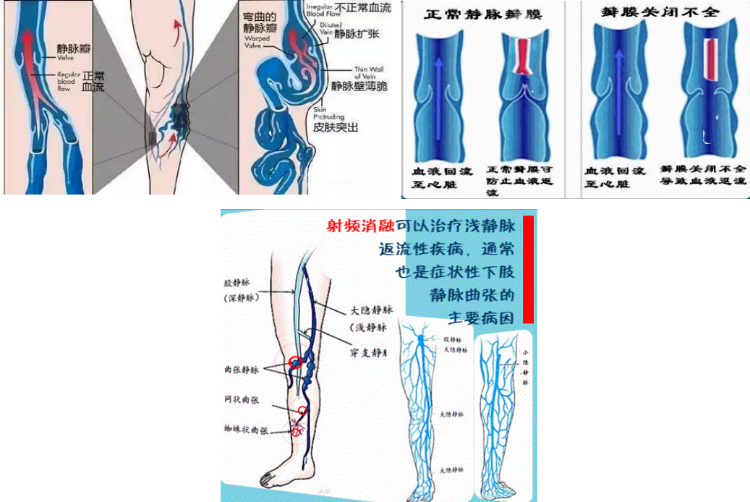 重医三院·医疗动态丨多技术联合 个性化治疗——重医大附三院下肢静脉曲张诊疗中心开展多例微创诊疗