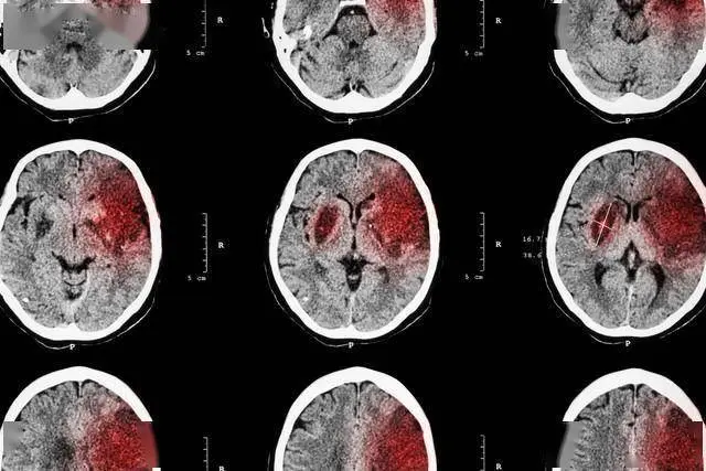 45岁男子深夜脑梗离世，医生提醒：这几类食物害了太多人