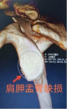 一“镜”维“稳”！康复大学青岛中心医院微创手术让关节重回稳定