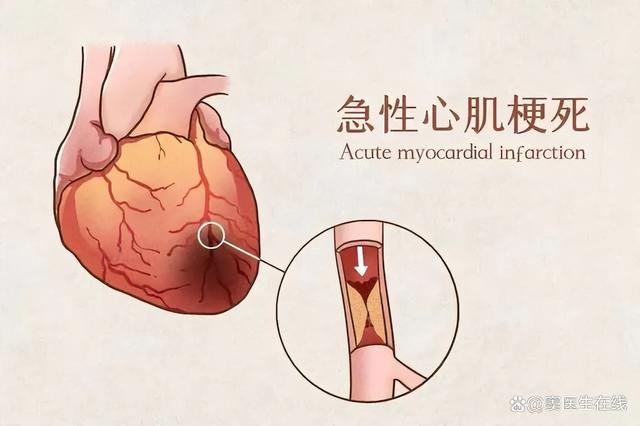 医生查明原因，再次突发心梗是因为心脏支架内形成血栓