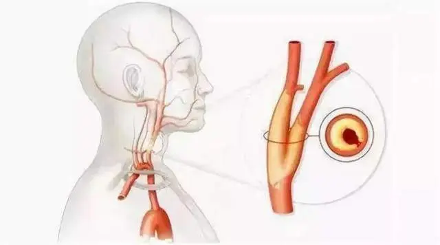 不可忽视的“颈部隐患”：颈动脉斑块！斑块如何形成？如何检测？