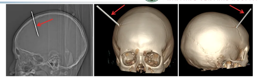 烤串钢签刺入小儿颅内，在信阳市中心医院成功获救