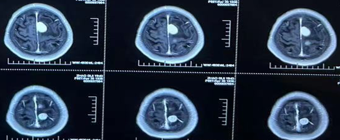 手术纪实|这家医院神经外科为高龄多发脑膜瘤患者成功实施手术