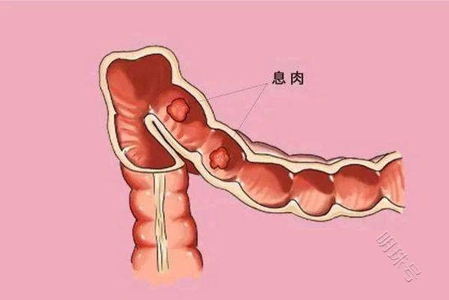 若这2处“发臭”，或是大肠长了息肉，科普小知识