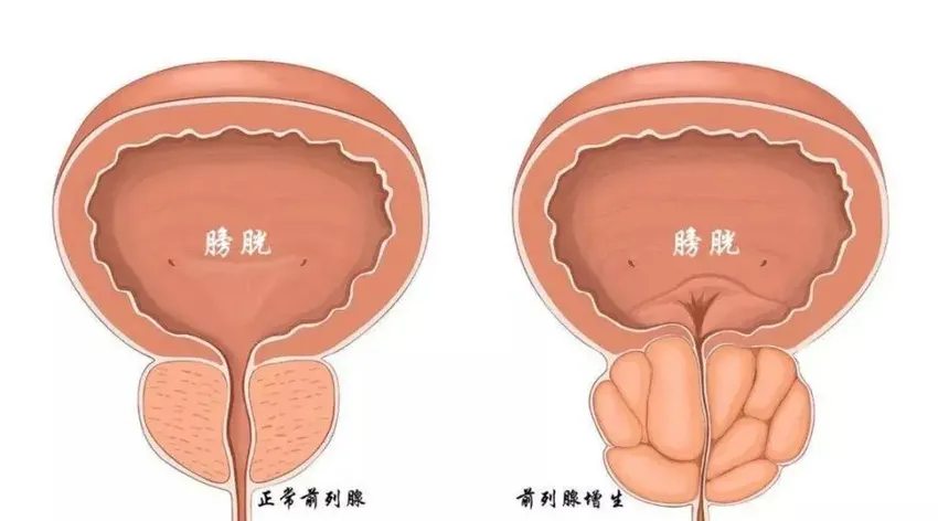 前列腺增生有哪些潜伏的信号？做好10个预防，守护男性健康