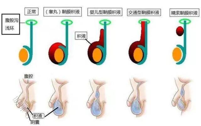 宝宝私处有包块，到底是疝气还是鞘膜积液，分析下