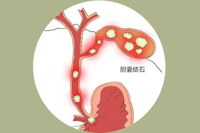 得了胆结石会出现哪些症状？医生提醒：这9类人群容易得胆结石！