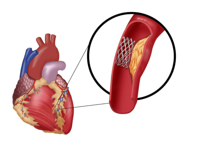 放置心脏支架后，做好这4点，帮你延长寿命
