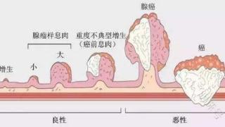 为什么肠道容易长息肉？肠息肉会发生癌变吗？一文解答