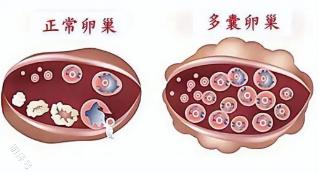 吃出健康，调理多囊