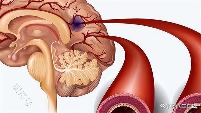 为何脑梗患者越来越多？建议听听医生怎么说