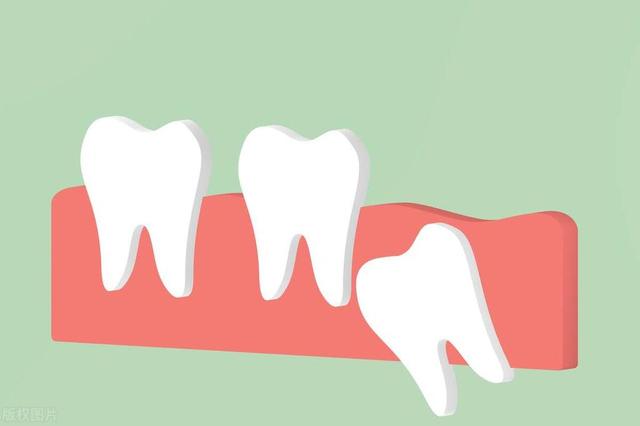 你的智齿需要拔吗？医生提示：“不良智齿”不拔有多危险！