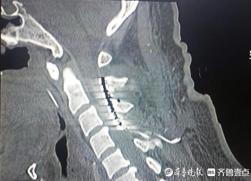 滕州中心人民医院神经外科二病区开展脊髓电刺激术助昏迷患者促醒