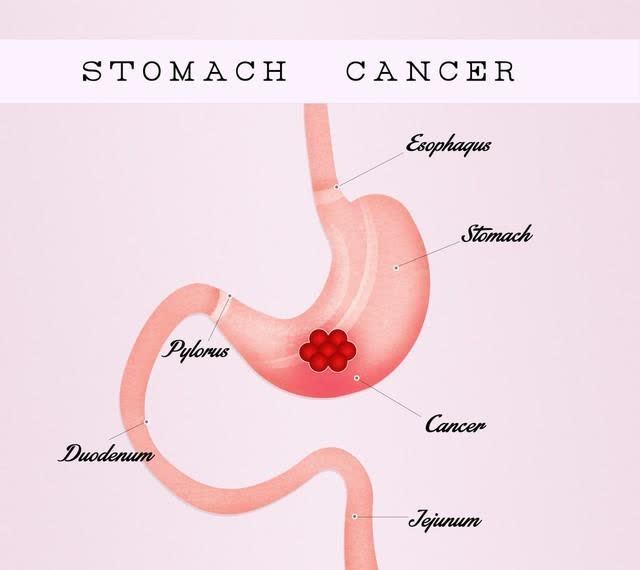 胃部患癌和喝水有很大关系？研究200名胃癌患者得出答案