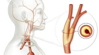 一旦发现颈动脉斑块，必须终身服药，真是这样吗？一文解答