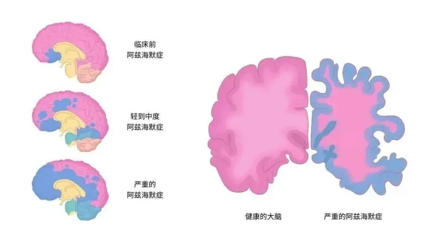 阿尔茨海默病会家族遗传？女性患病几率高于男性，最小患者年仅19岁