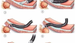 淄博市妇幼保健院成功应用内镜隧道技术剥离胃黏膜下肿瘤