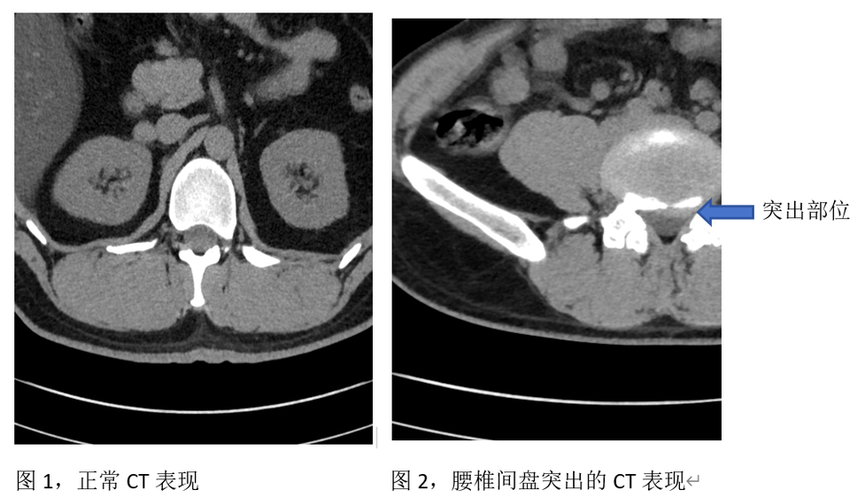 腰椎间盘突出了，内服中药也能“喝回去”？