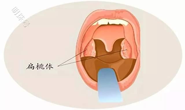 郑州民生耳鼻喉医院：腺样体肥大的危害、手术指征及预防方法