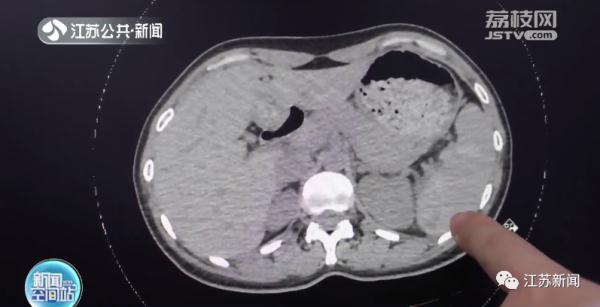 常州一女子摔伤后未引起重视，结果引起迟发性脾破裂