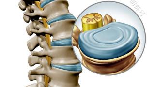 腰间盘做微创能管几年？了解下