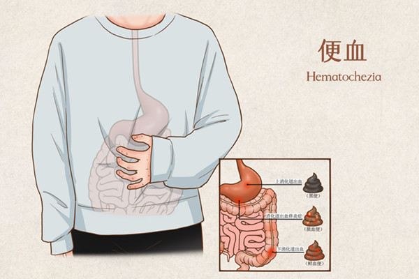 上厕所拉血怎么回事