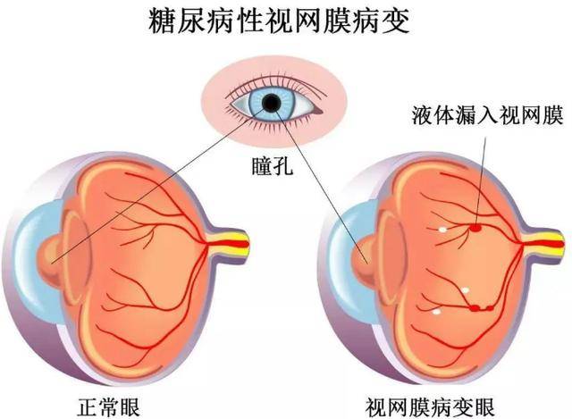 为何糖尿病越来越常见，糖尿病有哪些危害