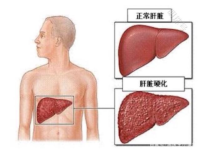 患上肝癌有哪些前兆和表现？一文科普下