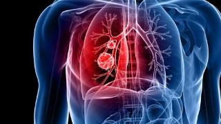 肺癌多数是“拖”出来的，若身体有这3种“怪象”，最好别忽视！