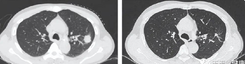 体内有癌，“腿”先知？提醒：若腿上有3个迹象，尽早做筛查