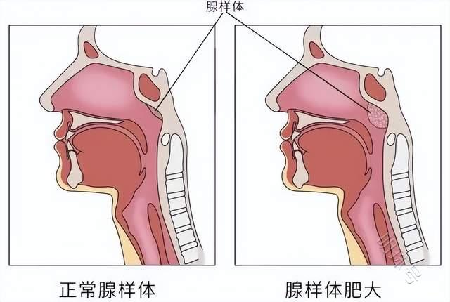 郑州民生耳鼻喉医院：腺样体肥大的危害、手术指征及预防方法