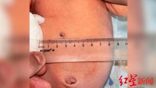 俄罗斯孕妇生下腹部中弹的女婴