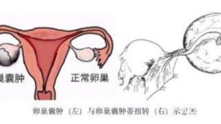 女子骑马后下腹痛 竟因体内一器官扭转了两圈