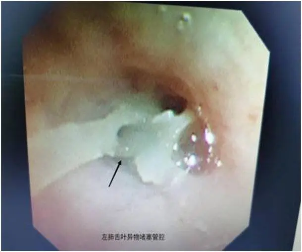 成都1岁宝宝咳喘久久不愈，竟是4根鱼骨藏在气管7个月！