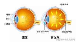 高度近视，需警惕青光眼！