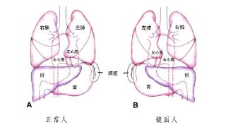 发生率百万分之一！海南一女子竟是罕见“镜面人” 手术要“反向做”