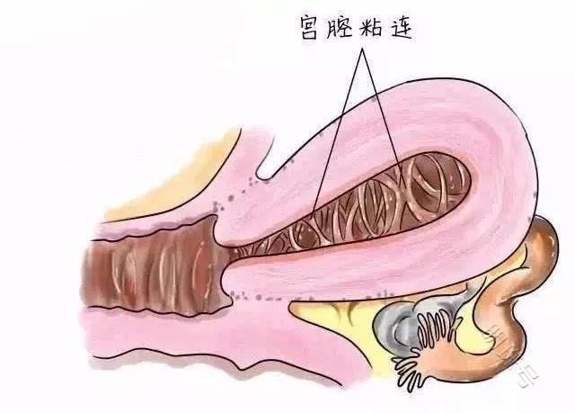 什么是宫腔粘连?宫腔粘连有哪些临床表现?