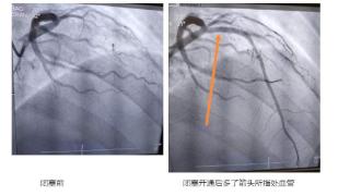 小伙阳了后胸闷，医生一查惊了！呼吸困难、血氧饱和度低…这个救命姿势记住→